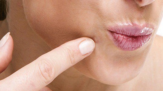 How to Get Rid Of Warts Naturally