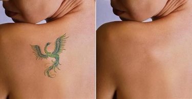 tattoo removal creams, Best tattoo removal creams