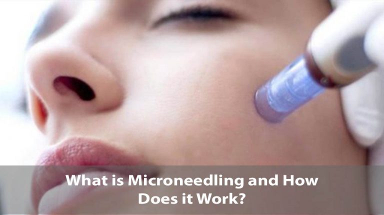 What is Microneedling is and How Does it Work?