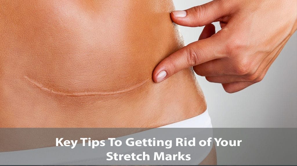 Key Tips To Getting Rid of Your Stretch Marks