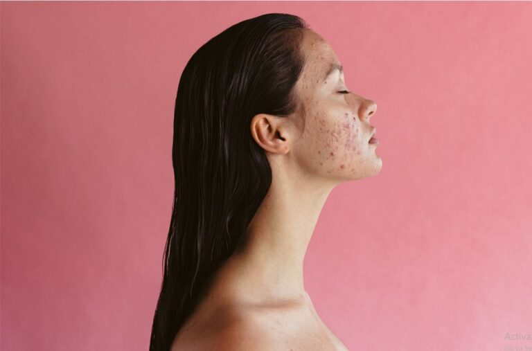 11 Expert Tips For Acne-Prone Skin
