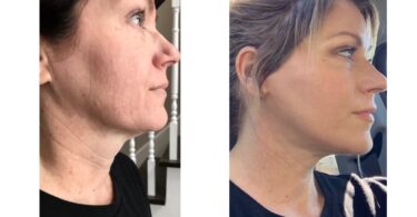 How is a Ponytail Facelift Done?