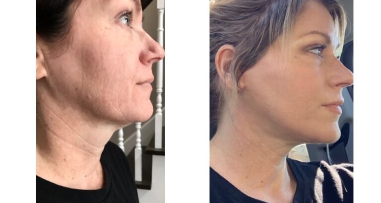 How is a Ponytail Facelift Done?